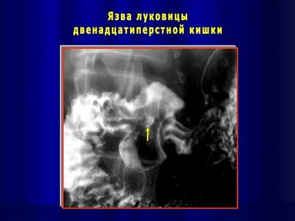 Деформация луковицы двенадцатиперстной кишки