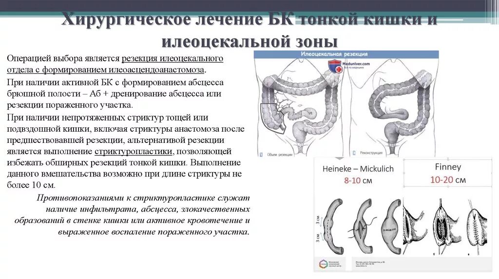 Илеоцекальная инвагинация кишечника. Илеоцекальная резекция кишечника. Резекция илеоцекального отдела кишечника.