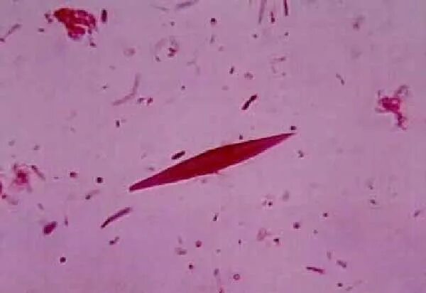 Спирали куршмана и кристаллы шарко-лейдена в мокроте определяются. Кристаллы шарко лейдена. Микроскопия мокроты спирали куршмана. Спирали куршмана и кристаллы шарко-лейдена в мокроте. Клетки шарко лейдена.