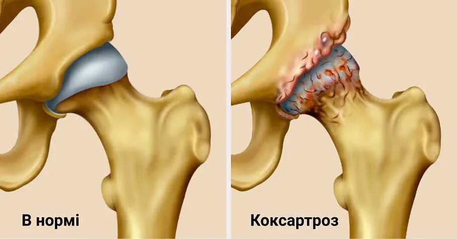 Коксоартроз