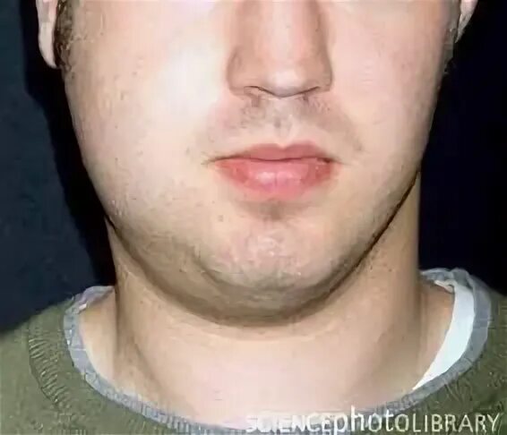 Свинка болезнь симптомы. Эпидемический паротит у взрослых. Болезнь свинка паротит симптомы. Эпидермальный паротит. Свинка у взрослых мужчин.