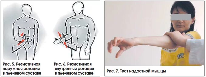 Болит плечо при отведении руки