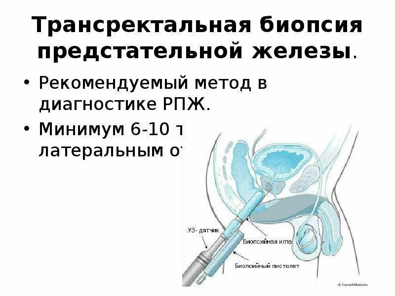 Простаты через прямую кишку. Трансректальная биопсия предстательной железы. сатурационная биопсия простаты. fusion биопсия предстательной железы. схема проведения биопсии простаты.