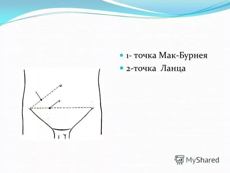 Точка мак бурнея при аппендиците. Точка мак бурнея при аппендиците. Точка ланца и мак бурнея топографическая. Точка мак бурнея при аппендиците. Точка мак бурнея при аппендиците.