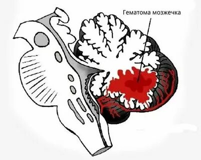 Последствия мозжечка