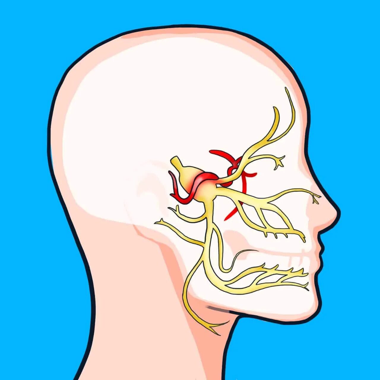 Невралгия тройничного нерва. Невралгия тройничного нервв. Воспаление тройничный нерв неврология. Neuralgia тройничный нерв.