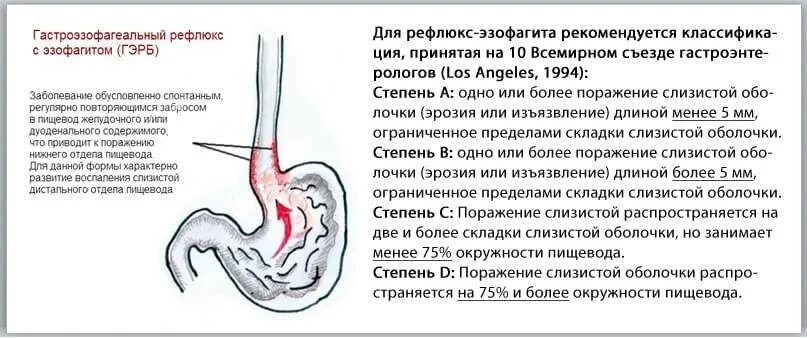 Рефлюкс желудка симптомы. Гэрб и рефлюкс эзофагит отличия. эрозивный рефлюкс эзофагит степень а. эрозивный эзофагит рефлюкс гастрит.