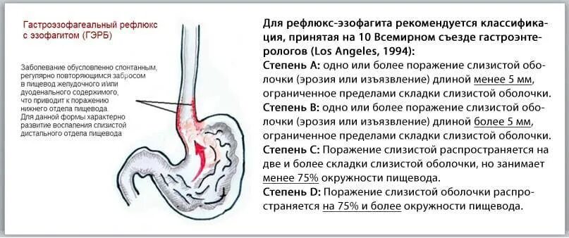 Диффузная пищевода. Рефлюкс эзофагит и ГЭРБ отличие. Эрозивный гастрит рефлюкс эзофагит.