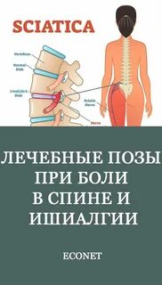 Ишиалгия что