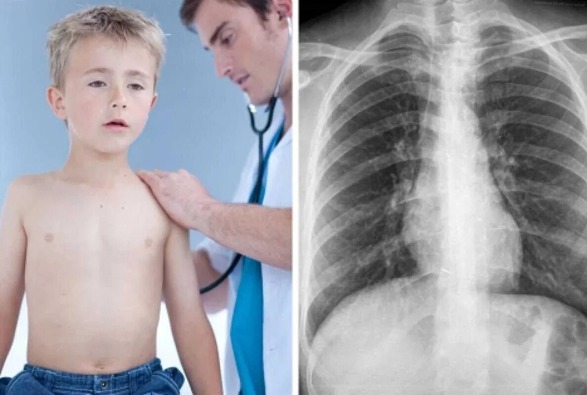 При обструктивном бронхите у детей развивается. Бронхиальный бронхит у детей. Бронхиальный бронхит у детей. Бронхиальный бронхит у детей. Бронхиальная астма бронхоспазм.