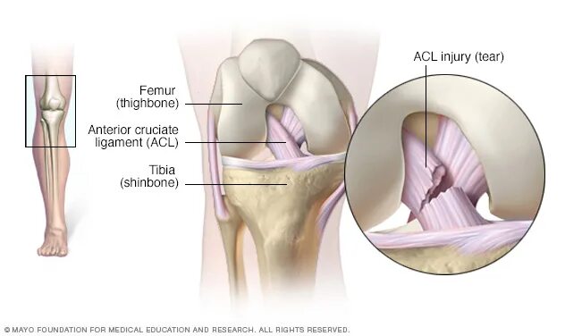 Acl что это. ACL колено связки коленного. Разрыв связок ПКС коленного сустава. Отрыв передней крестообразной связки. Разрыв передней крестообразной связки.