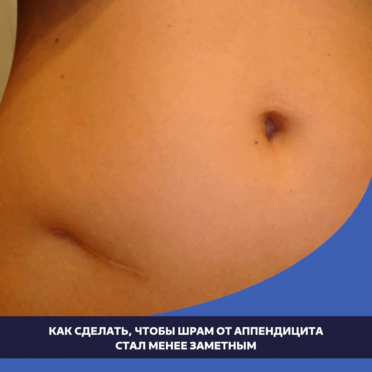 Как сделать, чтобы шрам от аппендицита стал менее заметным Медицинский центр "АТ