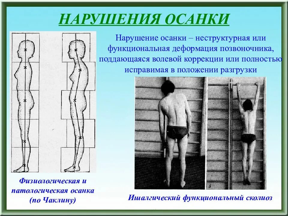 Деформация позвоночных. Функциональная деформация позвоночника. функциональное искривление позвоночника это. деформация осанки. патологическая осанка.