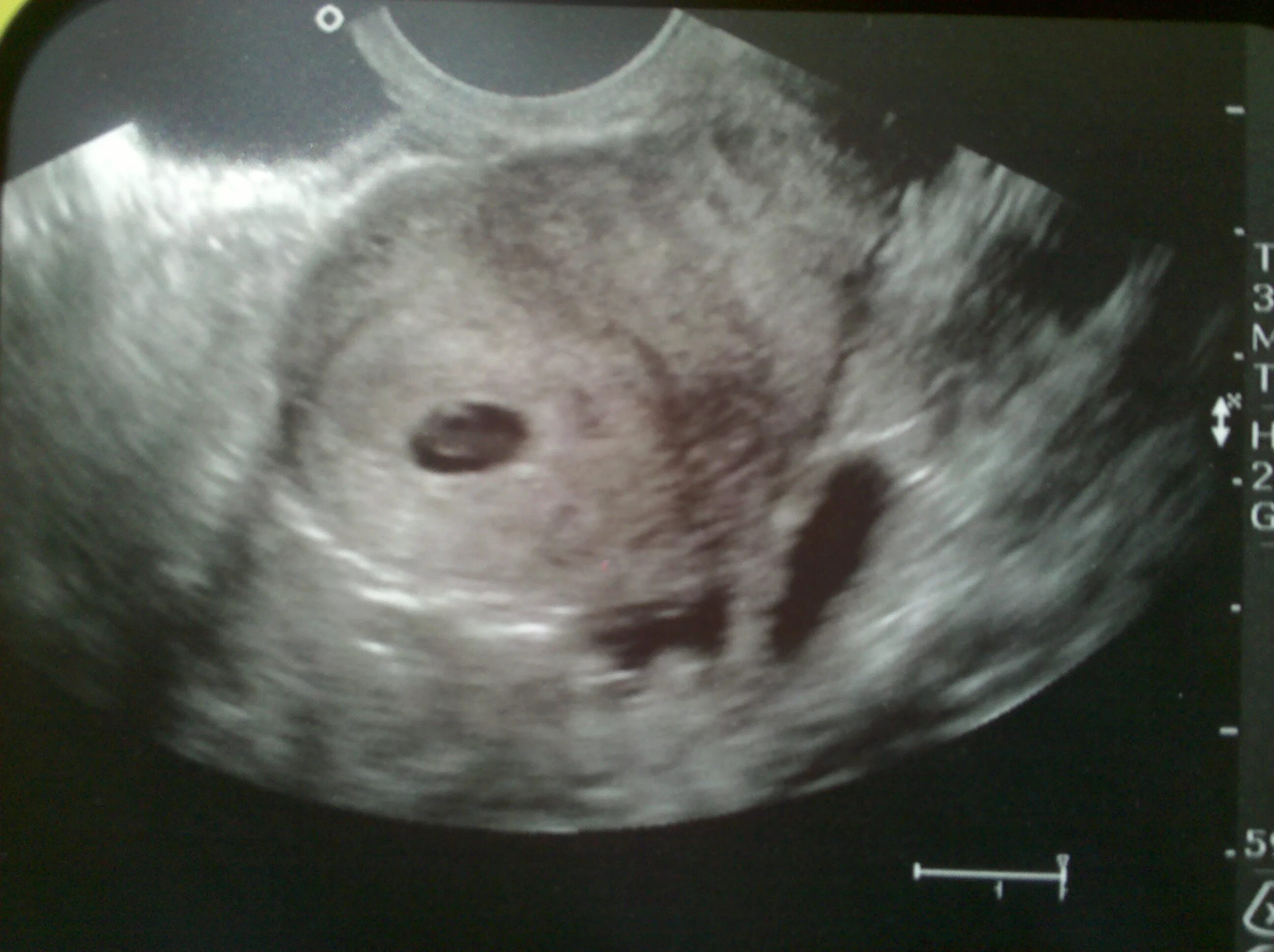 Плод на 1 неделе беременности. 3 Недели беременности фото плода на УЗИ. УЗИ две недели беременности. УЗИ 7 недель беременности.