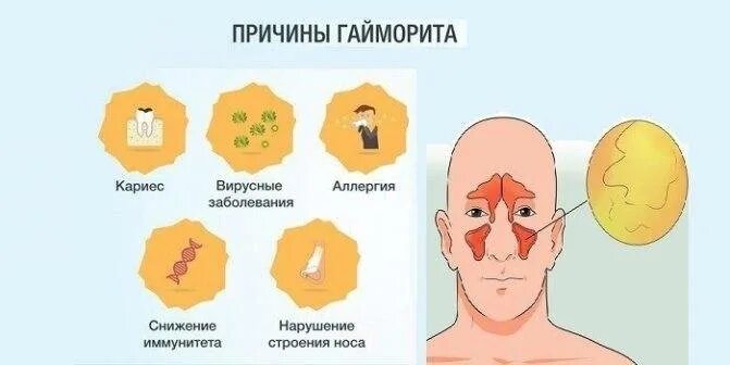Как лечить синусит у взрослых без температуры. Гайморит внешние факторы. гайморит причины возникновения. гайморит симптомы у взрослых.