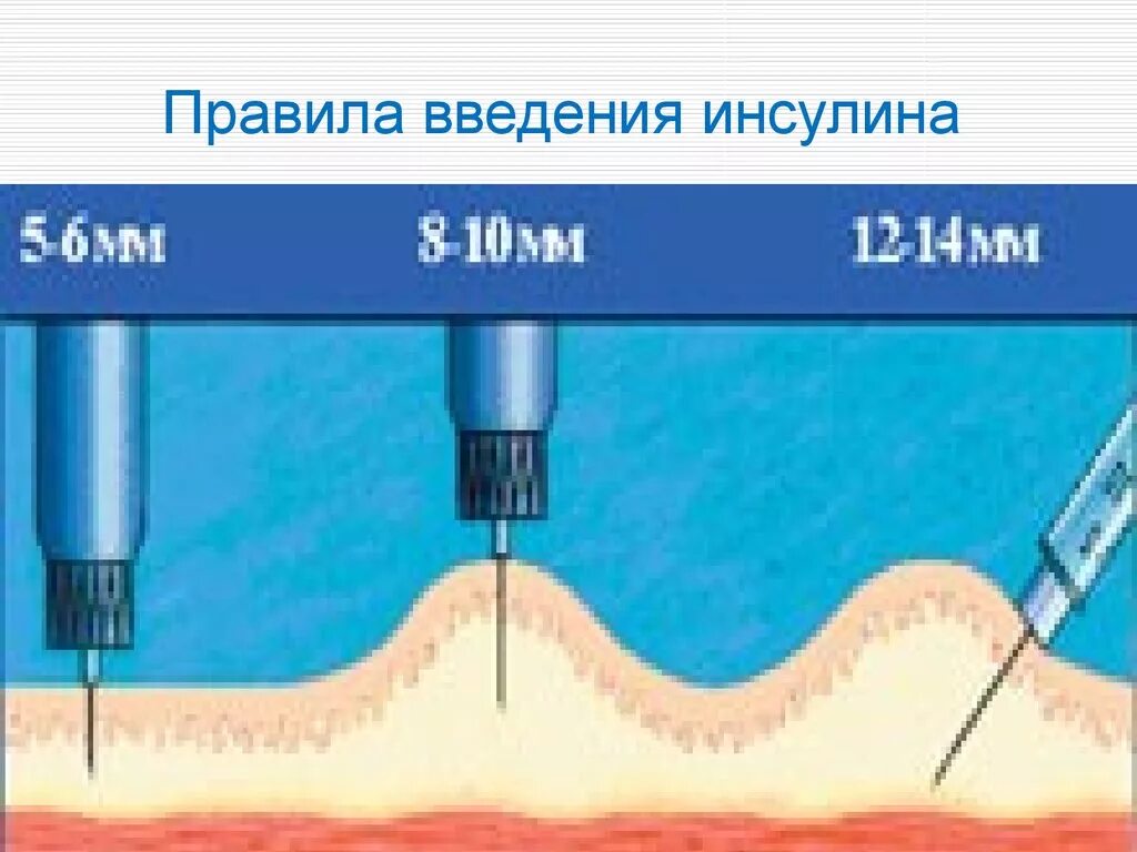 Подкожная глубина введения иглы. Алгоритм инъекции инсулина подкожно. Техника введения инсулина подкожно шприц ручкой. Внутрикожная инъекция инсулин. Техника введения инсулина шприц ручкой алгоритм.