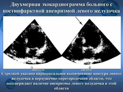 Аневризма инфаркт