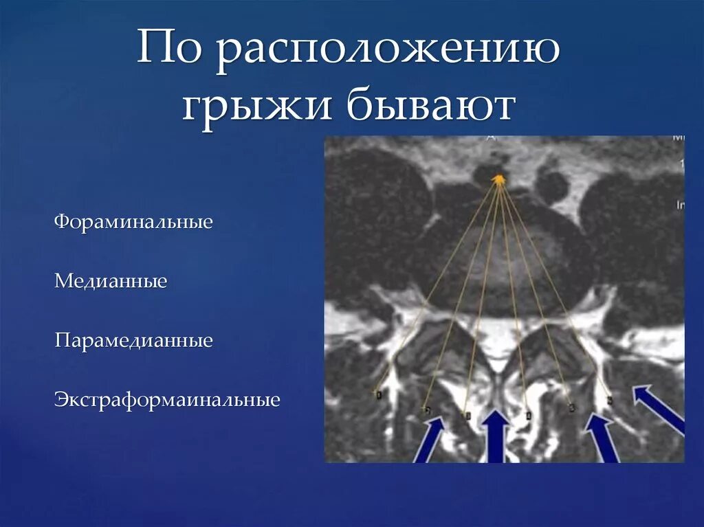 Медианно парамедианная билатеральная. Фораминальная протрузия мрт. Парамедианные грыжи межпозвонковых дисков. Дорсалтная медианная грыжа.