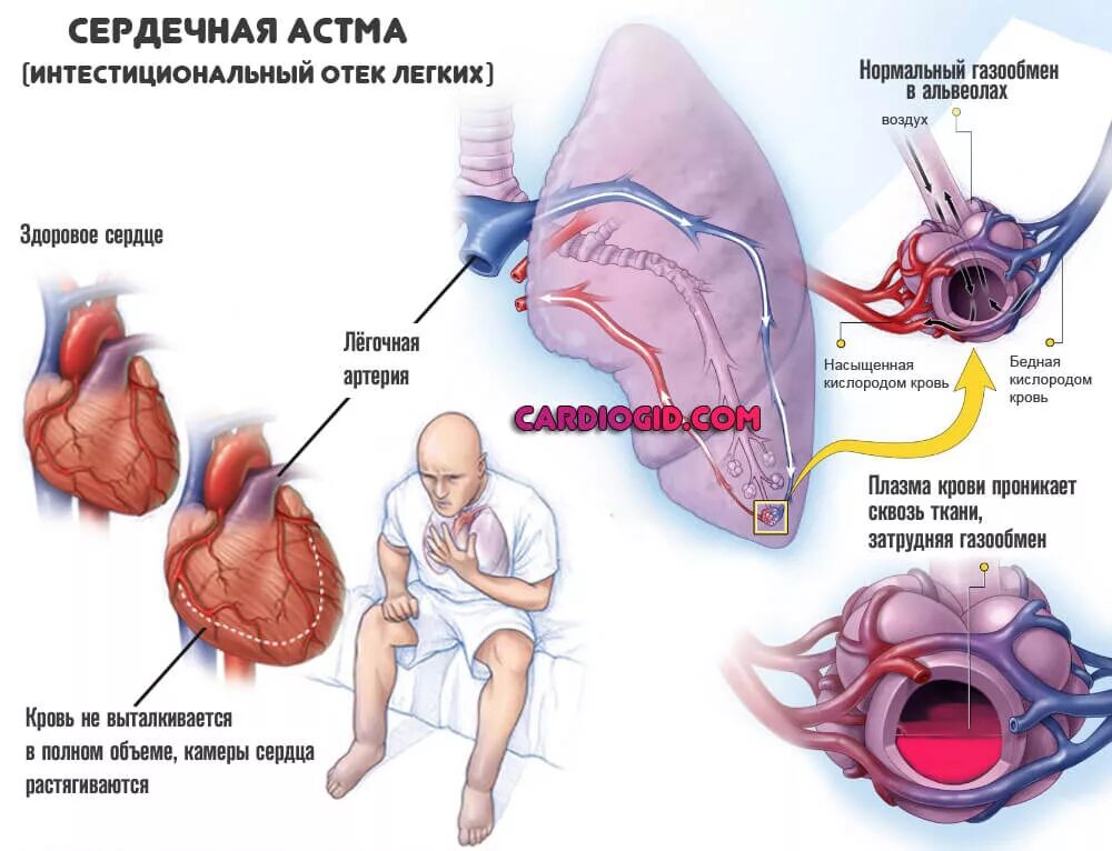 Легкие сердечные заболевания. Сердечная астма проявление недостаточности. Патогенез приступа сердечной астмы. Сердечная астма клинические проявления. Сердечная астма механизм развития.