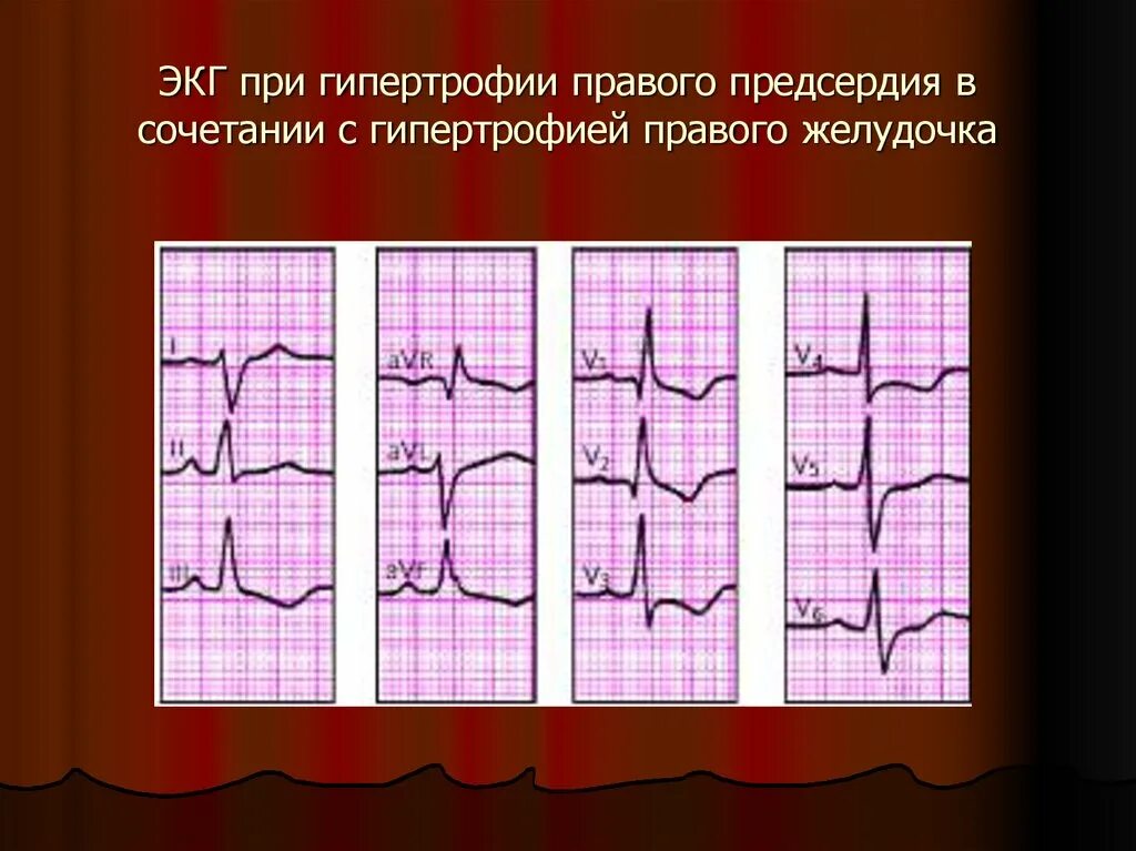 Гипертрофия левого предсердия левого желудочка. Гипертрофия левого предсердия и правого желудочка на ЭКГ. Гипертрофия правого желудочка на ЭКГ RSR Тип. Гипертрофия левого предсердия на ЭКГ. Гипертрофия правого предсердия сердца на ЭКГ.