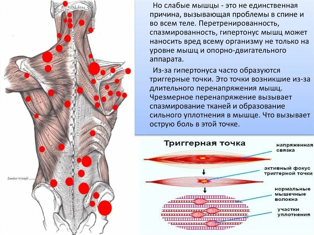 Карта триггерных точек. Триггерные точки на спине. Триггерные точки в мышцах спины. Триггерные точки на спине схема. Триггерные точки это простыми словами