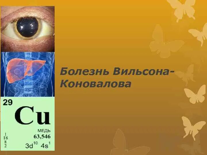 Синдром вильсона коновалова что это такое простыми. Гепатоцеребральная дистрофия Вильсона Коновалова. Формы болезни Вильсона-Коновалова. Болезнь в льсона. Болезнь Вильсона презентация.