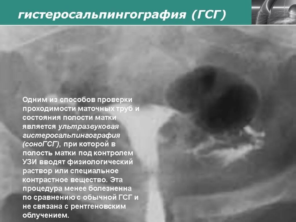 Можно забеременеть при непроходимости труб. Исследование проходимости маточных труб (гистеросальпингография. Непроходимость маточных труб УЗИ. ГСГ проходимость маточных труб.