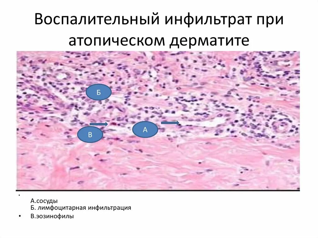 Лимфоидная инфильтрация что это. Воспалительный инфильтрат гистология. Атопический дерматит гистология. Гистологическое исследование кожи при атопическом дерматите. Аллергический дерматит гистология.