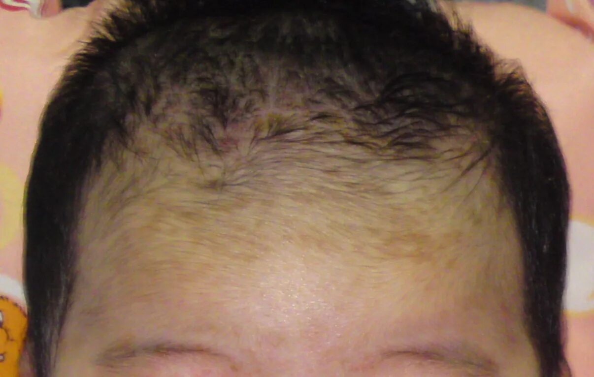 кожа лба у детей