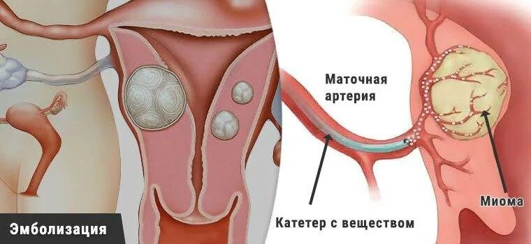 Эма миомы матки. Эмболизация миомы матки. эмболия маточных артерий при миоме матки.