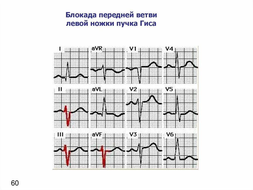 Неполная блокада передней. Блокады ветвей пучка Гиса на ЭКГ. Блокада левой ветви левой ножки пучка Гиса. Блокада ЛНПГ на ЭКГ. Блокада левой ножки пучка Гиса на ЭКГ.