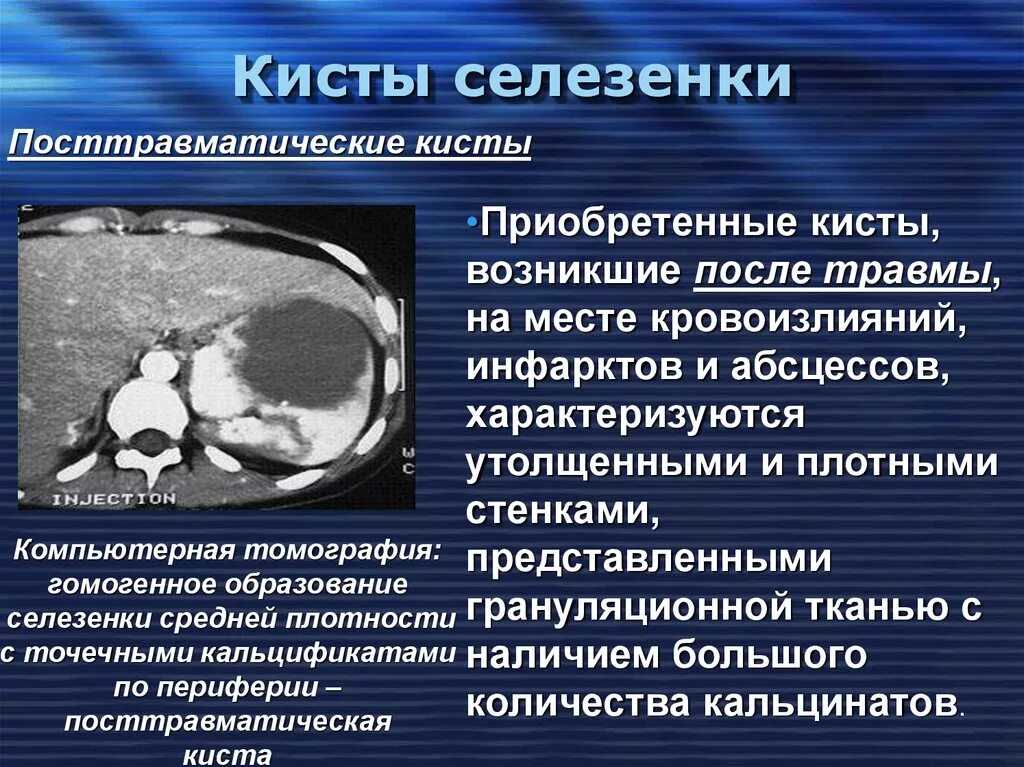 После операции селезенки. Селезенка Гиста. Паразитарная киста селезенки на кт.