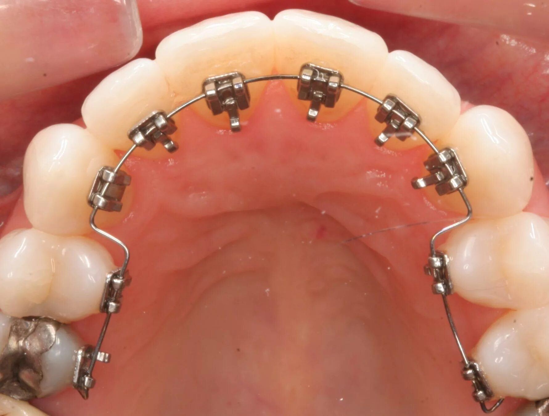Со внутренней стороны. Лингвальные накусочные брекеты. Невидимые (лингвальные) брекеты. Сапфировые лингвальные брекеты.