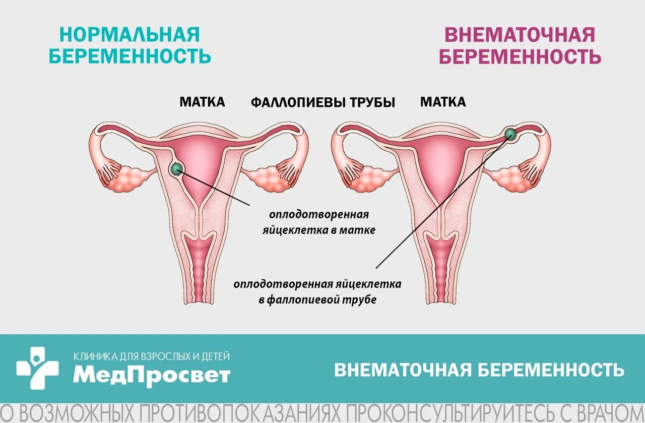 Беременность после внематочной отзывы