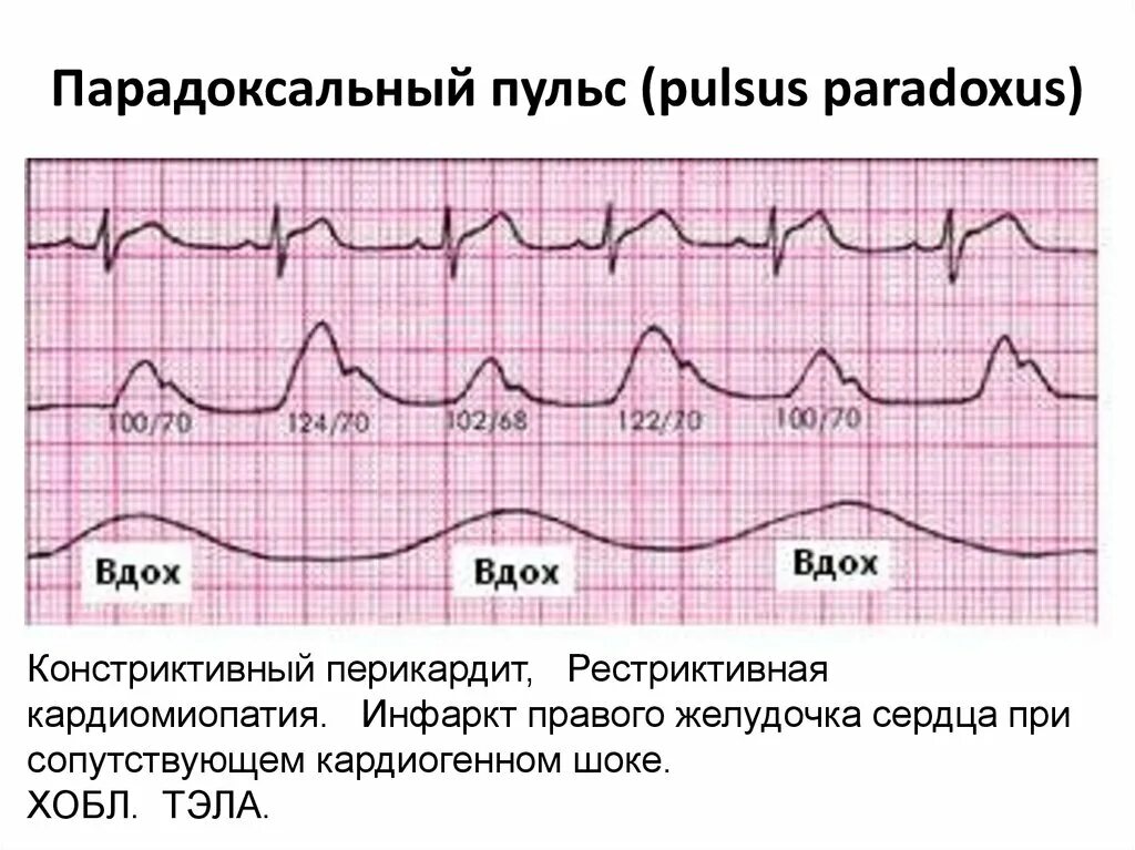 Почему пульс разный. Нормальный пульс схема. График пульса здорового человека. Нормальная диаграмма пульса. Нормальный график биения сердца.