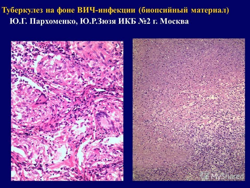 Туберкулез у вич больных рентгенограмма. Вич ассоциированный туберкулез легких. Туберкулез у вич больных рентгенограмма. Туберкулез у вич инфицированных. Туберкулез и вич инфекция.