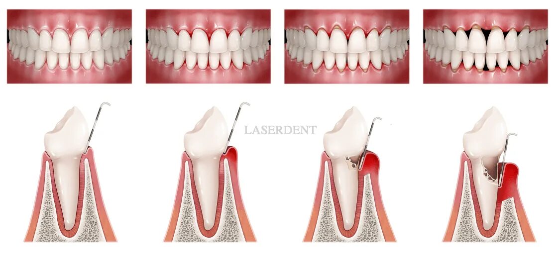 Пришеечный пародонтоз. Протетический пародонтит. Гингивит пародонтит периодонтит. Магазин десен