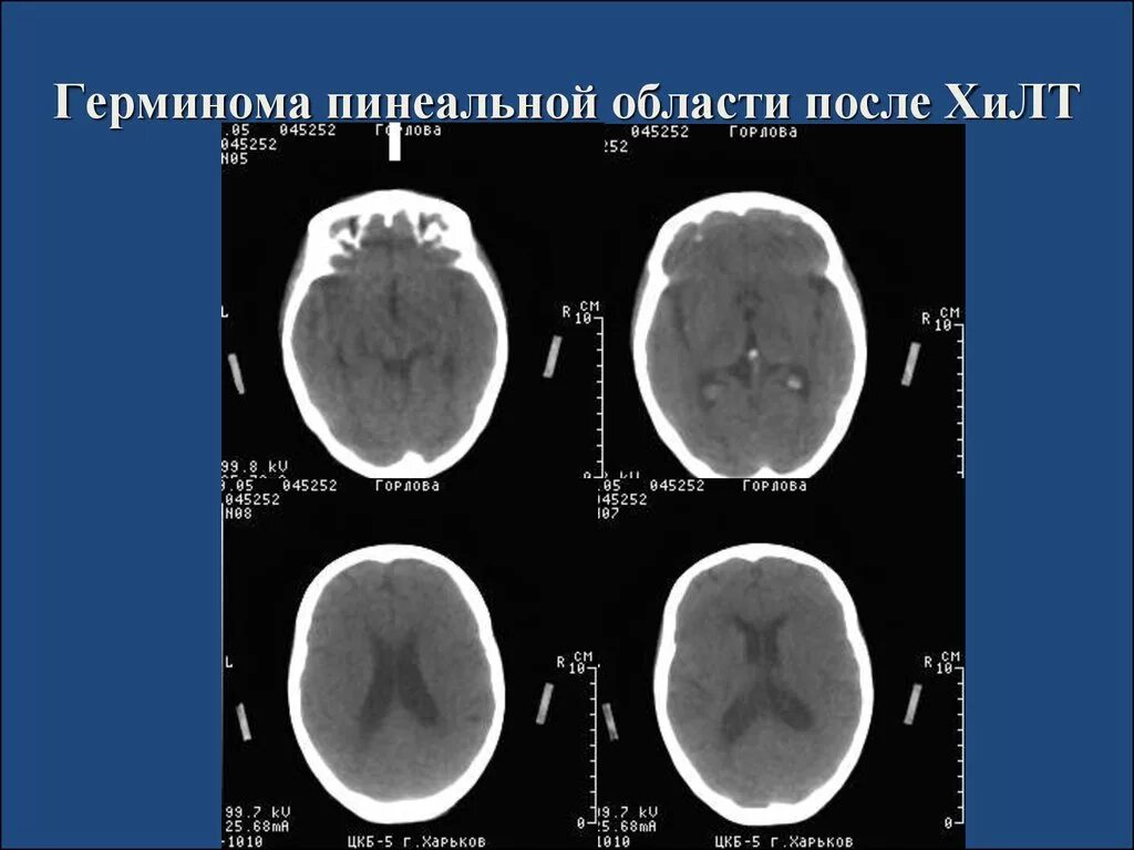 Герминома пинеальной области. Герминома головного мозга. Объемное образование пинеальной области. Опухоли пинеальной области. Герминома