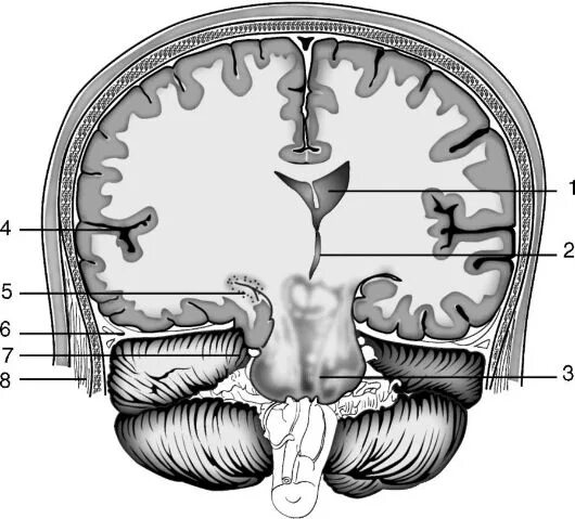 дислокация мозжечка