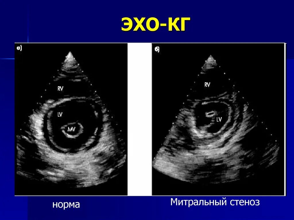 Стеноз митрального клапана на узи. Пролапс митрального клапана на эхокг степени. Стеноз аортального клапана эхокардиография. Эхо кг митральный стеноз. Эндокардит митрального клапана эхокг.