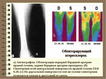 Облитерация это