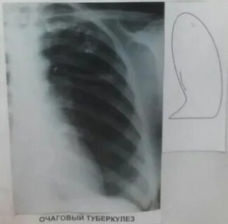 Туберкулез очаговые тени