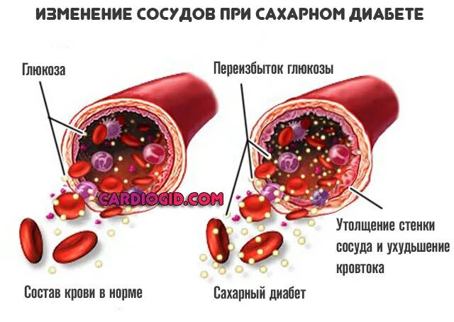 Диабетическая ангиопатия сосуды. Атеросклероз при сахарном диабете 2 типа. Изменение сосудов при сахарном диабете. Ангиопатии при сахарном диабете.