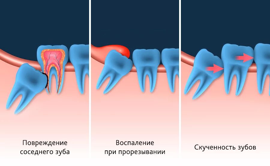 Почему зубы мудрости так называются. Удаленные зубы мудрости. Полуретинированный зуб мудрости. Зуб мудрости проростается.