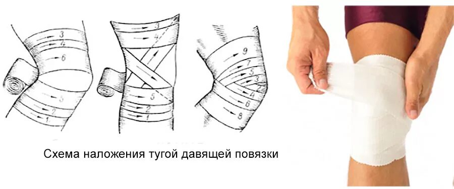 Бинтование коленного сустава эластичным бинтом. Тугая повязка. Эластичный бинт. Тугие повязки на суставы. Повязка на локоть при бурсите.