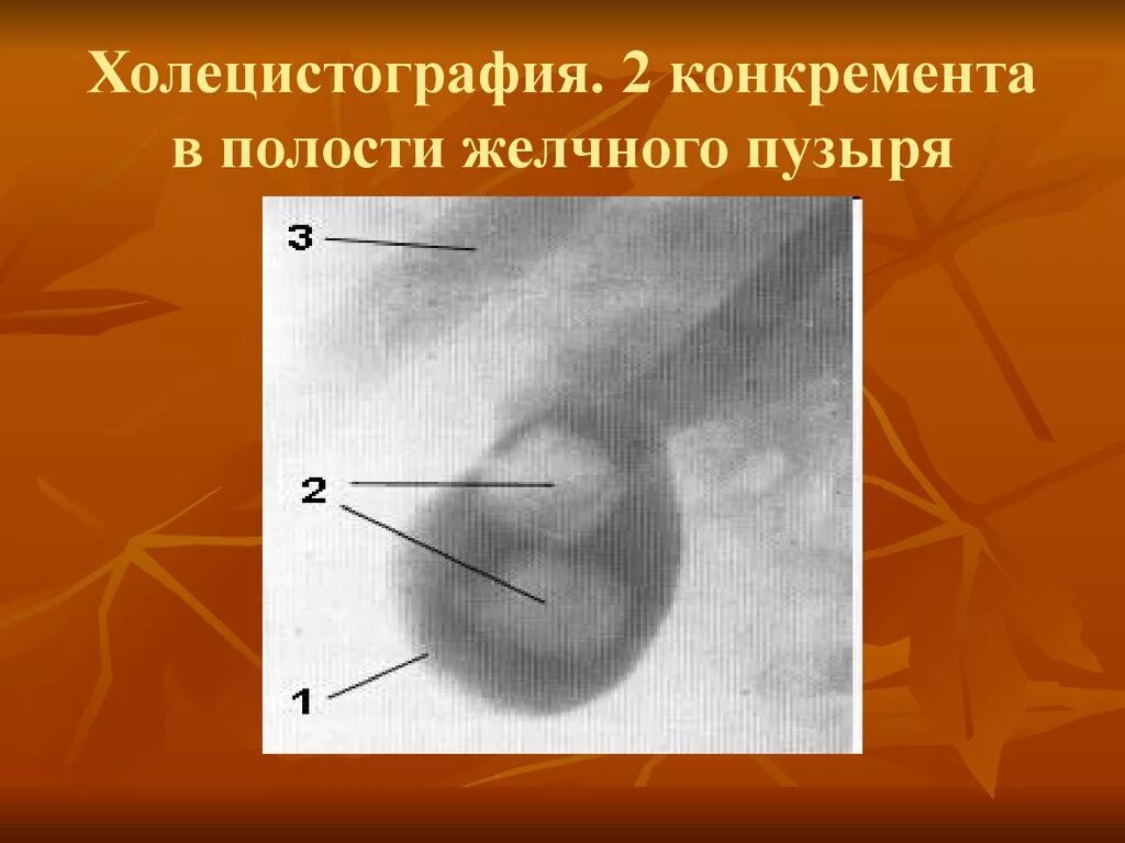 Пероральная холецистография. Ультразвуковая динамическая холецистография. Холецистография рентген. Холеграфия желчного пузыря.