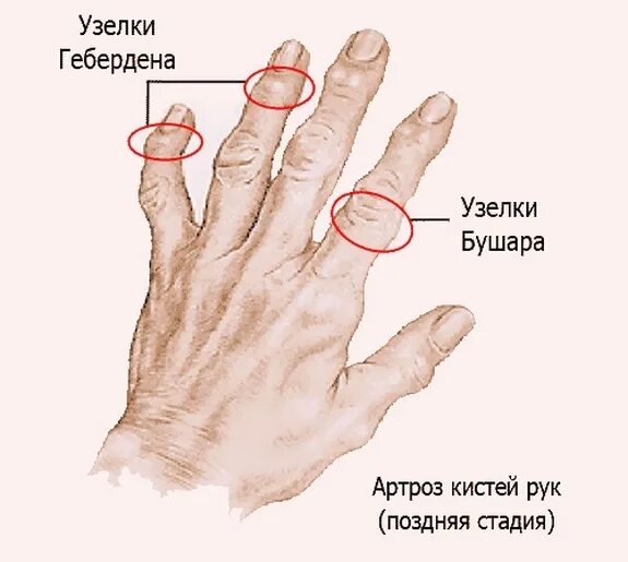 Болит основание сустава большого пальца. Узелков Гебердена и Бушара. Геберденовские узелки и узелки Бушара. Узелки Гебердена Бушара остеоартроз.