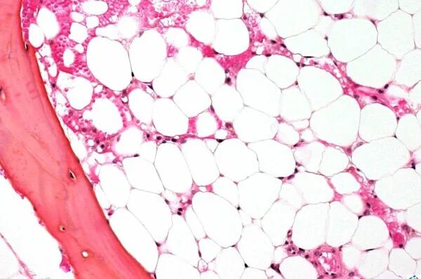 Гипо и апластические анемии. Апластическая анемия красный костный мозг. Апластический костный мозг. Апластический костный мозг. Апластическая анемия микропрепарат крови.