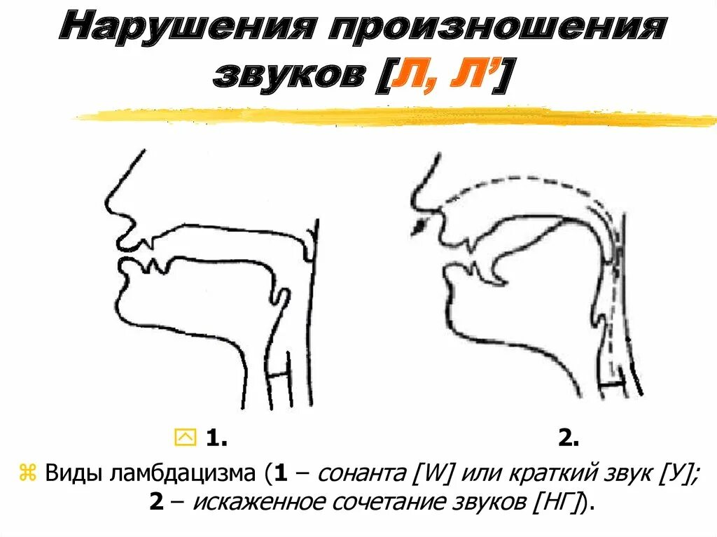 Как исправить горловое. Ламбдацизм артикуляция. Нарушение произношения звука л. Нарушения произношения звуков л л. Нарушенное произношение звука л.