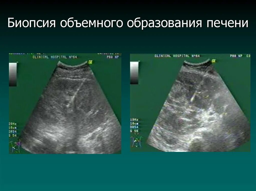 Биопсия печени отзывы. Чрескожная биопсия печени. Пункционная биопсия печени. Тонкоигольная биопсия печени. Биопсия образования в печени.